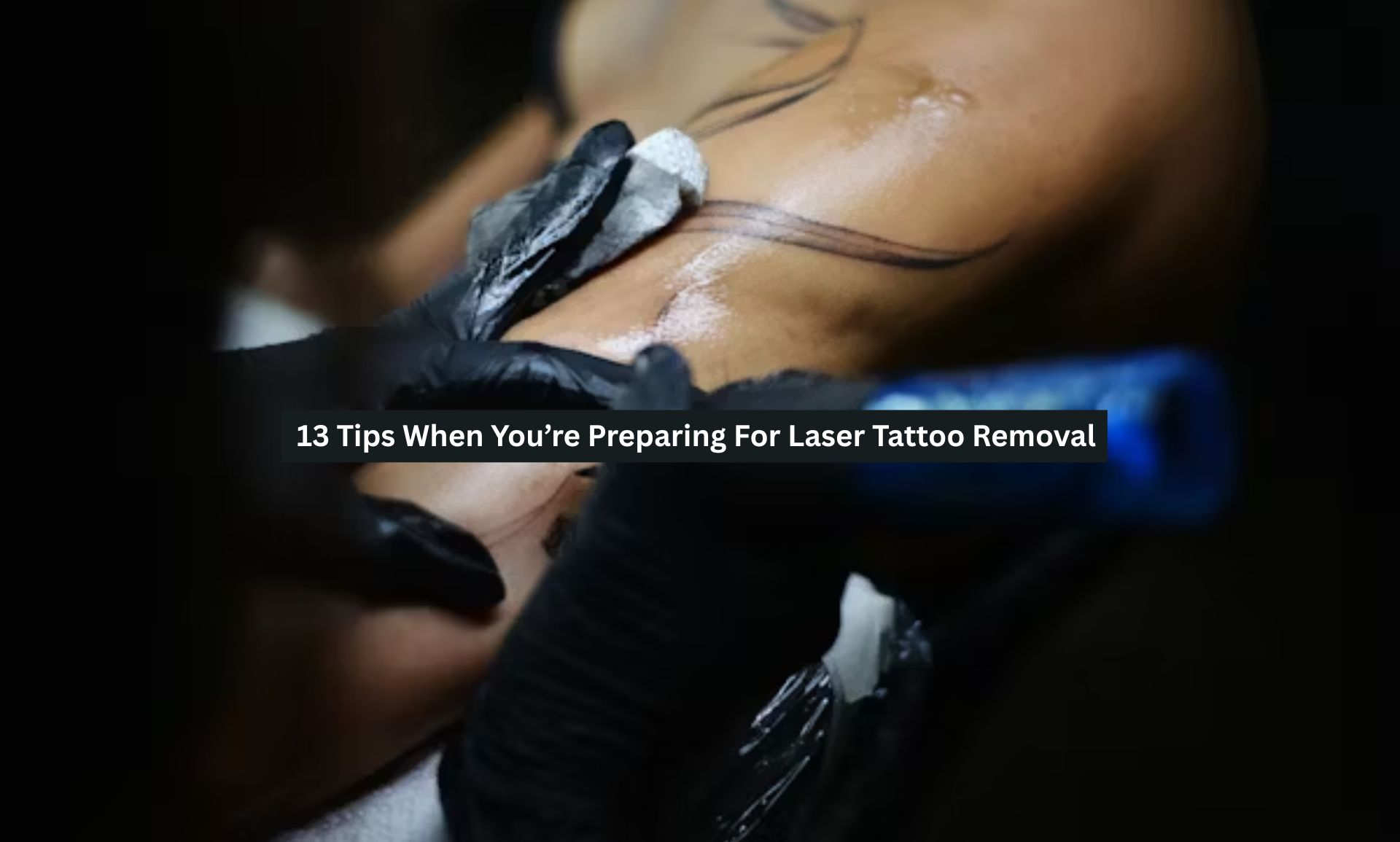 Laser Tattoo Removal